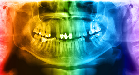 Panoramic radiograph is a panoramic scanning dental X-ray of the upper and lower jaw. This is a focal plane tomography shows the maxilla and mandible of a forty year old man.
