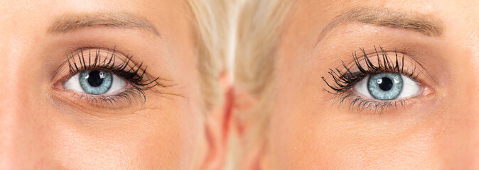 wrinkles cosmetic treatment, images composition showing results before and after crow's feet removal