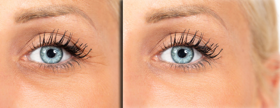 Crow's feet reduction, female eyes before and after botulin treatment