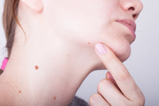 Wart Removal Images – Browse 44,353 Stock Photos, Vectors, and Video |  Adobe Stock