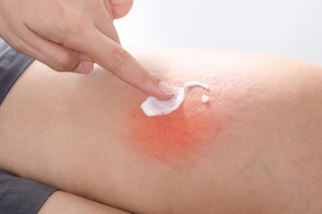 Scratch Allergic skin from mosquito or insect bites and apply medicine cream,Healthcare And...