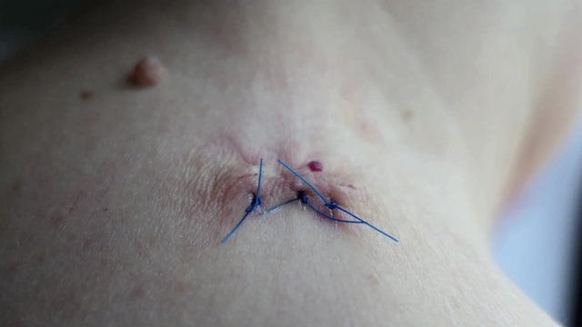 Stitches from the removal of a Sebaceous Cyst
