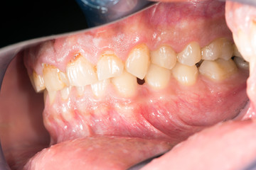 Side View Of Human Jaw With Overbite Dental Occlusion Closeup