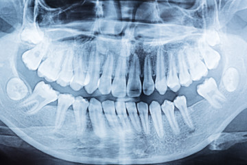 panoramic dental x-ray of a mouth left and right side.