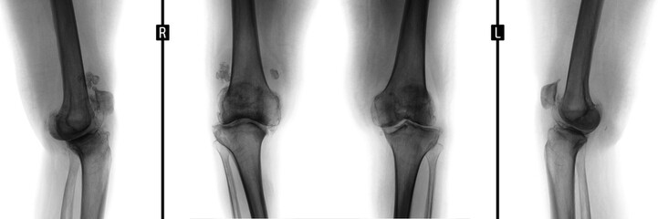 X-ray of the knee joints. Deforming arthrosis. Negative.
