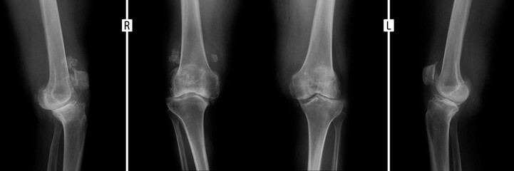 X-ray of the knee joints. Deforming arthrosis.  - obrazy, fototapety, plakaty