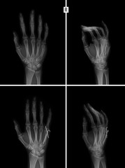 X-ray of the hand. Fracture of the 5rd metacarpal bone. Reposition. Osteosynthesis. 