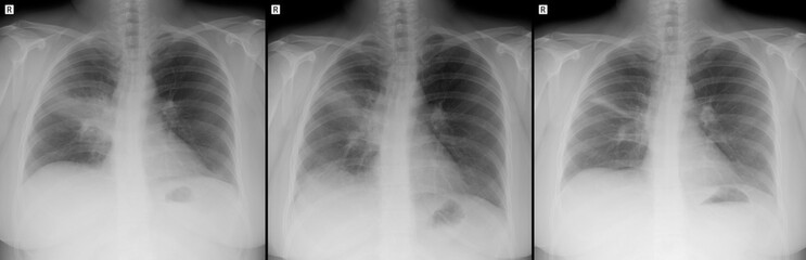 X-ray of the lungs. Pneumonia of the lung right. 