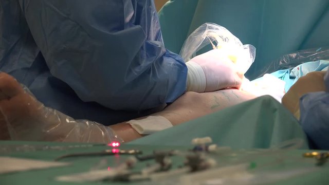 Endovenous laser ablation (EVLA) is a commonly used and very effective minimally invasive therapy to manage leg varicosities.