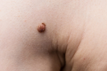 Unrecognizable person having dark fibroma, dermatology problem on skin. Close up of papilloma dermatosis