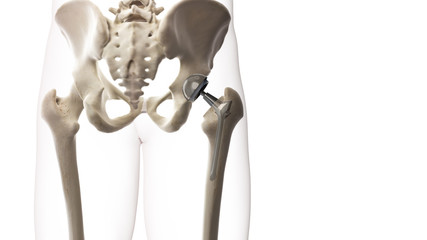 3d rendered medically accurate illustration of a hip replacement