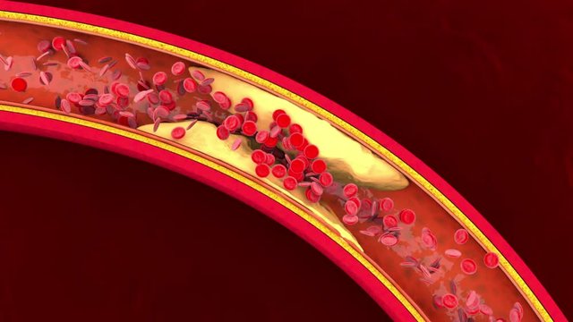 3D rendered Animation of Hemoglobin cells flowing through a clogged Artery developing the illness Arteriosclerosis.

