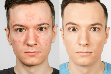 two guys before-after: left guy with acne, red spots, problem skin, right guy with healthy skin....