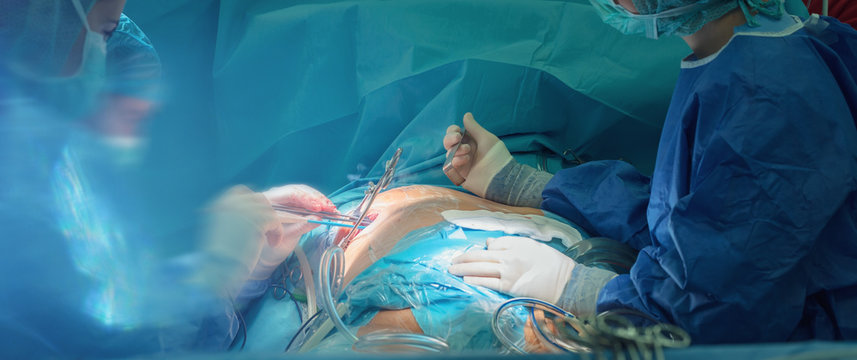 open heart cardiac surgery in hospital cardiovascular microsurgery with minithoracotomy procedure, surgeon operating beating heart surgery with his medical team