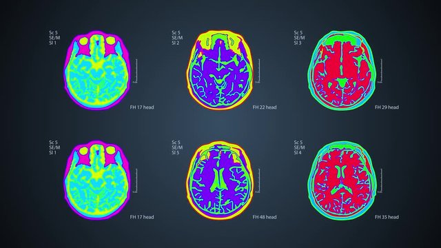 Brain MRT scan. 6 views on one screen.  Each video is loopable. 4k medical colorful background