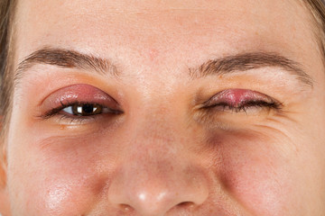 Fototapeta premium Chalazion - Eyelid infection