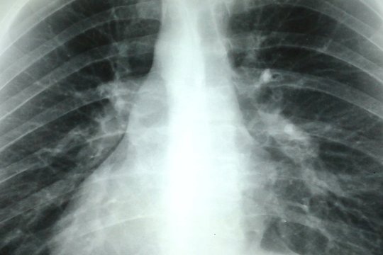 X-ray image of human lungs and chest area