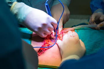 Team of Surgeons Operating in the Hospital. Close-up hands, team of doctors during surgery.