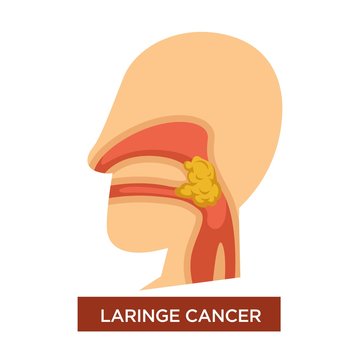 Laringe cancer illness malignant tumor in throat