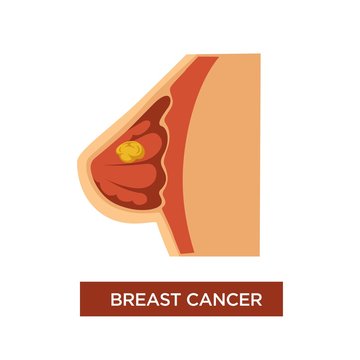 Breast cancer female oncology and tumor in chest