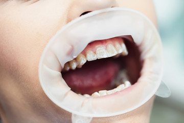 Close-up of frontal view of woman white teeth with retractor in dental office
