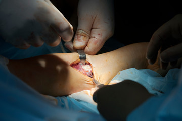 Forearm Surgery Closeup
