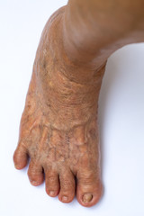 Fototapeta premium Skin Blood Varicose veins on right foot, Damaged toenail, Crooked toes in Senior women, White background, Close up & Macro shot, Selective focus, Body part, Healthcare concept