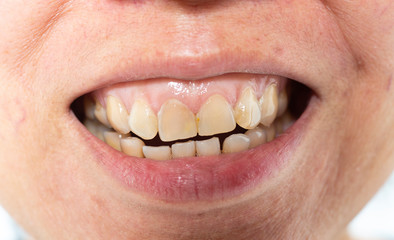 Asian Woman is showing  tartar on frontal teeth, plaque and gingivitis, Close up & Macro shot, Selective focus, Unhealthy denture