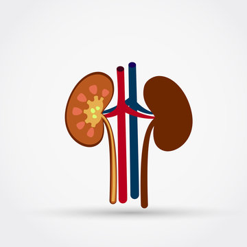 Stones in the kidney flat design vector illustration.