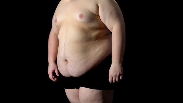 View to fat belly man, metabolic disorder, stomach resection, liposuction