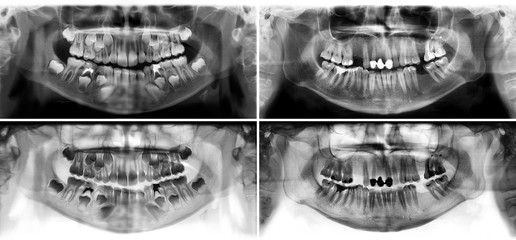 Panoramic radiograph is a scanning dental X-ray of the upper jaw maxilla and lower jawbone...