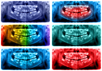 Panoramic radiograph is a scanning dental X-ray of the upper jaw maxilla and lower jawbone mandible. The photo shows a child aged 7 seven years © feelisgood