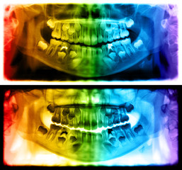 Panoramic radiograph is a scanning dental X-ray of the upper jaw maxilla and lower jawbone mandible. The photo shows a child aged 7 seven years