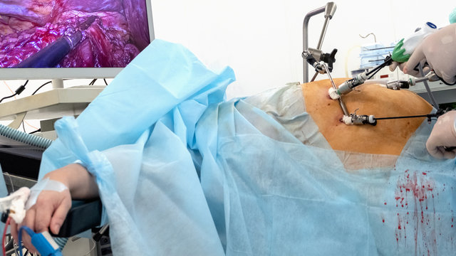 Endoscopy. The surgery is broadcast online to a high-definition monitor or television. Endovideosurgery. Doctors using endo-instruments operate a fat woman in the operating room of the hospital.