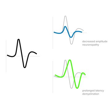 Graphic Waves Of Electromyographic Medical Examination - Vector