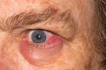 Swollen eye infection on mature woman