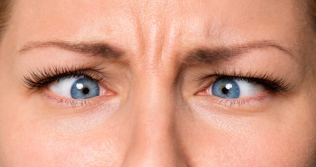Pretty Woman eyes suffering from strabismus. Close up of crazy female eyes with squint. Cute girl with mad, comic or surprised face.
