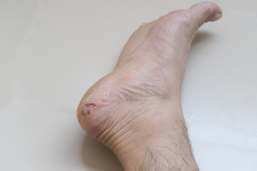 A foot with severe skin disease and itch