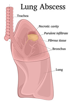 Illustration Of Lung Abscess