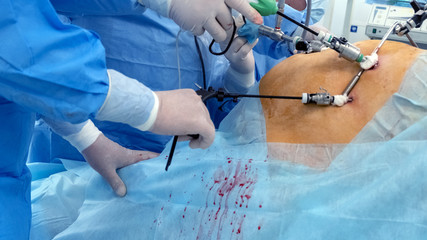 Modern advances in medicine. Endoscopy. Doctors use endo-instruments and video cameras to perform surgery in the abdominal cavity of a fat woman. The procedure in the operating room of the hospital