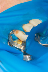Dental caries. Filling with dental composite photopolymer material using rabbders. The concept of...
