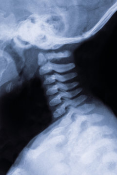 X-ray of neck and cervical spine of 3 month old baby .Side view. Old bluring image.