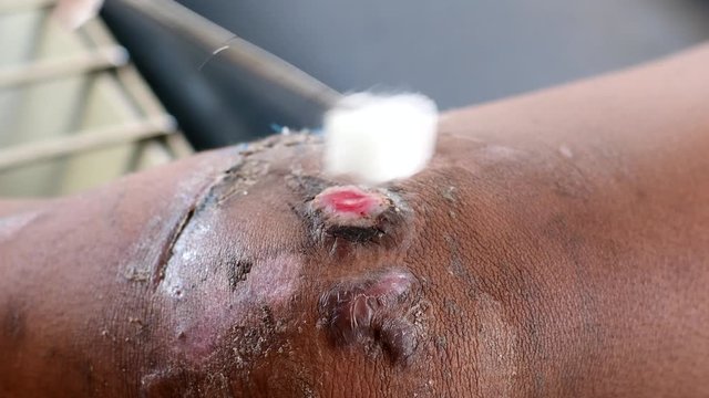 cleaning infected wound on knee 