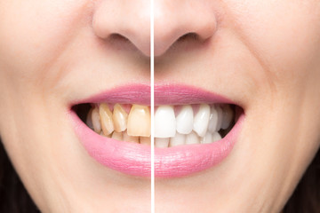 Close up of female yellow teeth before and after whitening treatment