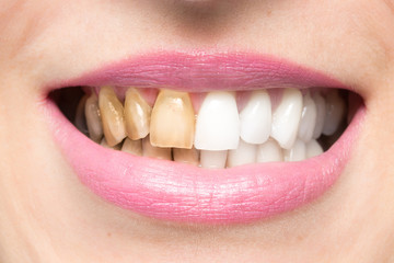 Close up of brown yellow teeth of woman for smoke addiction before and after whitening treatment