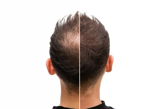 Vorher Nachher - Halbglatze eines Mannes mit Haarausfall
