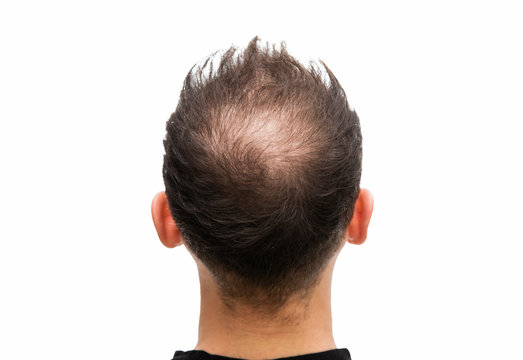 Halbglatze eines Mannes mit Haarausfall
