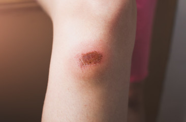 Fototapeta premium Abrasion on the woman's knee. Injured leg with a red wound. Medical treatment for first aid.