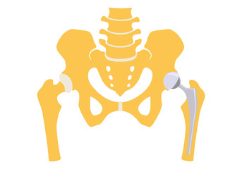 Total hip replacement. Vector illustration. - obrazy, fototapety, plakaty