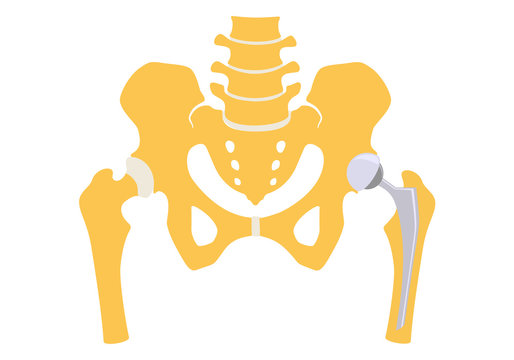 Total hip replacement. Vector illustration.